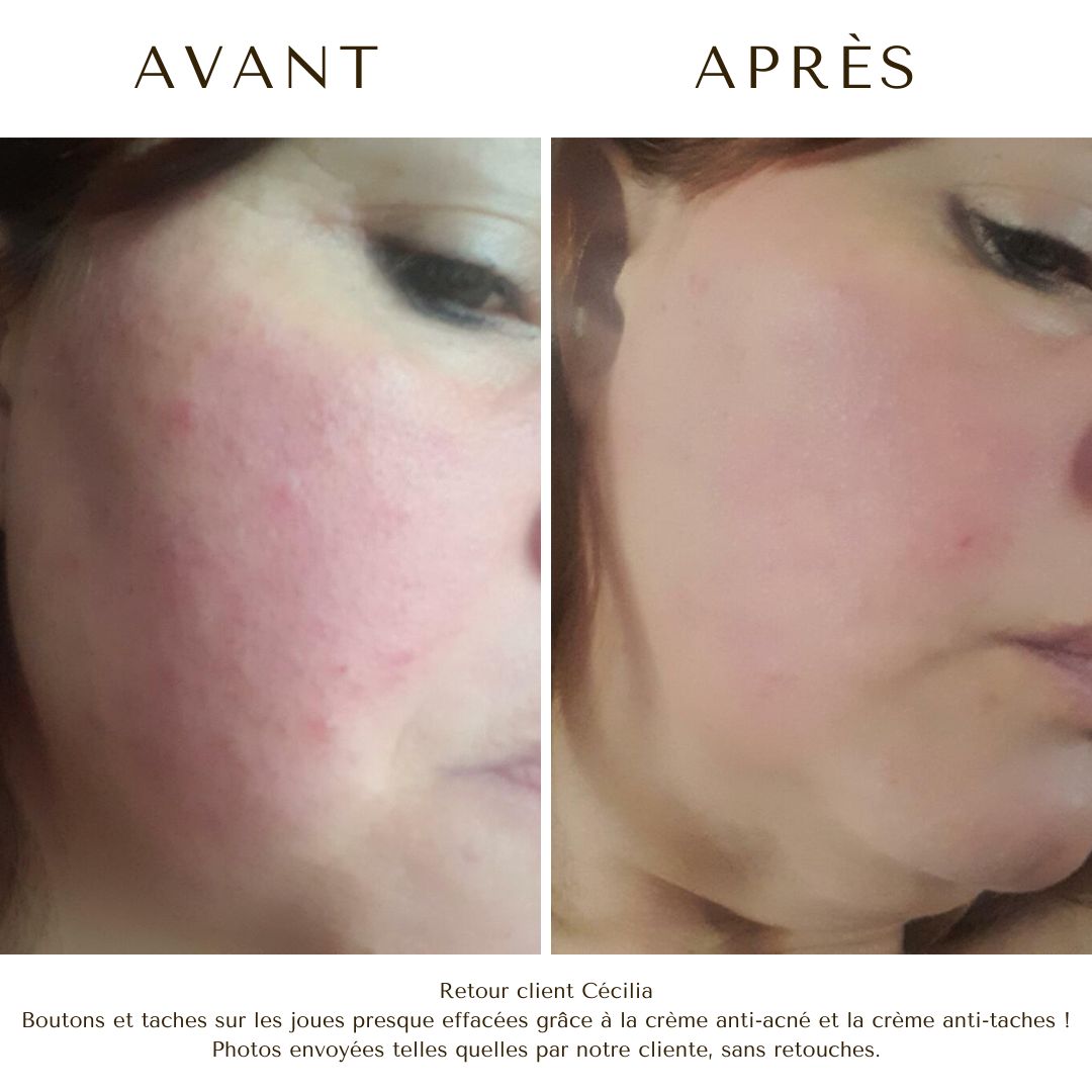crème acné layli layli avis crème anti acné bio crème layli huile poils anti poils Bild